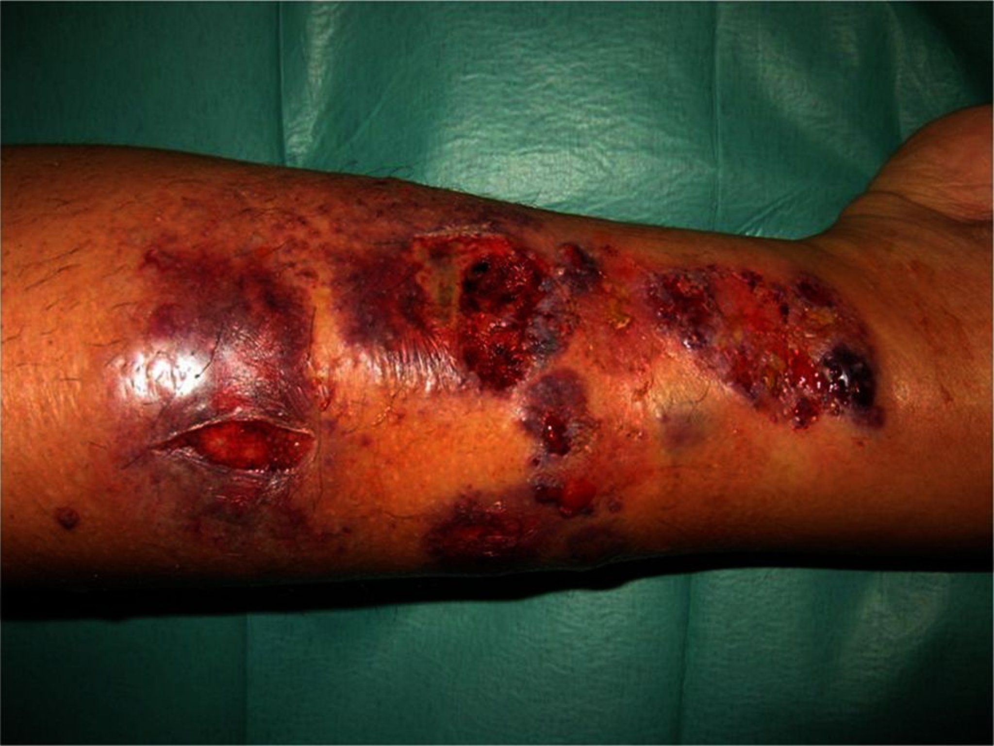 Pioderma gangrenoso subtipo bolhoso (atípico)