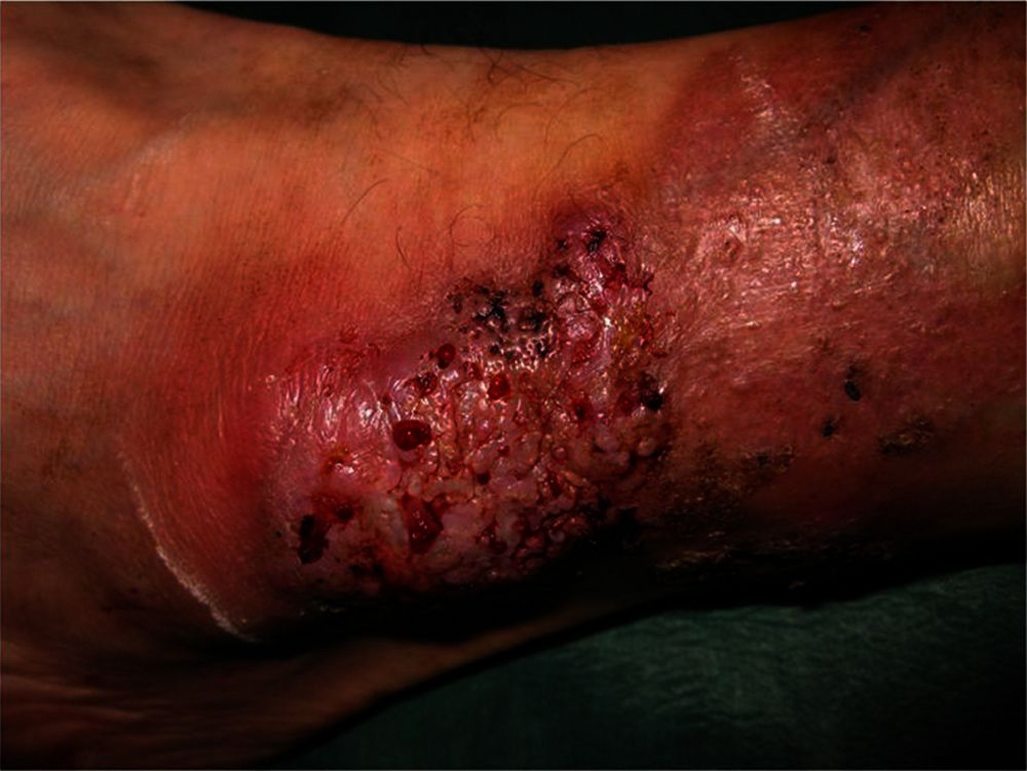 Vegetativer (oberflächliche granulomatöse Pyodermie) Subtyp mit Pyoderma gangraenosum