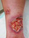 Pioderma gangrenoso, subtipo ulceroso (clásico)