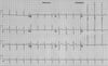 Linksventrikuläre Hypertrophie im EKG