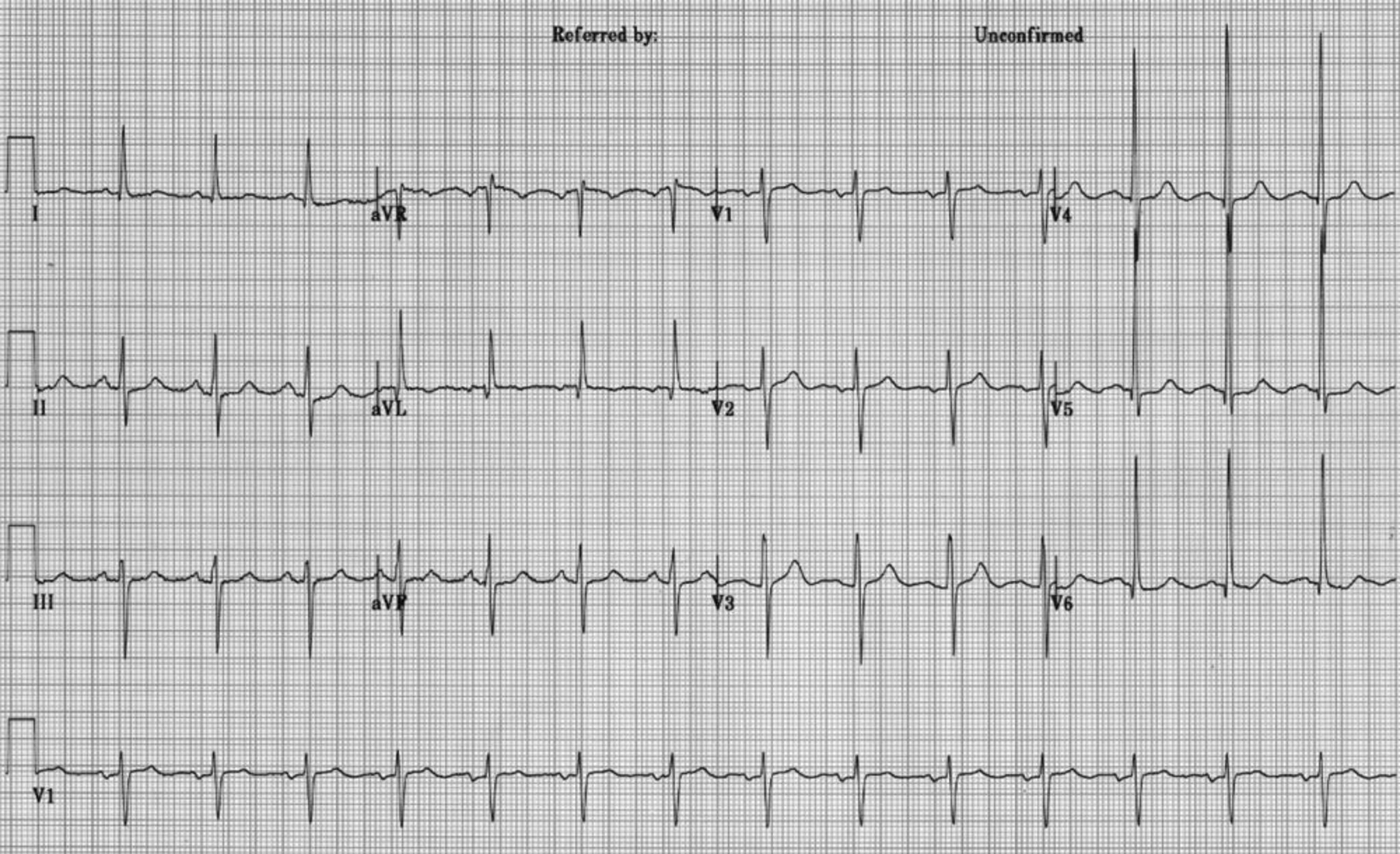 Hipertrofia ventricular esquerda no ECG