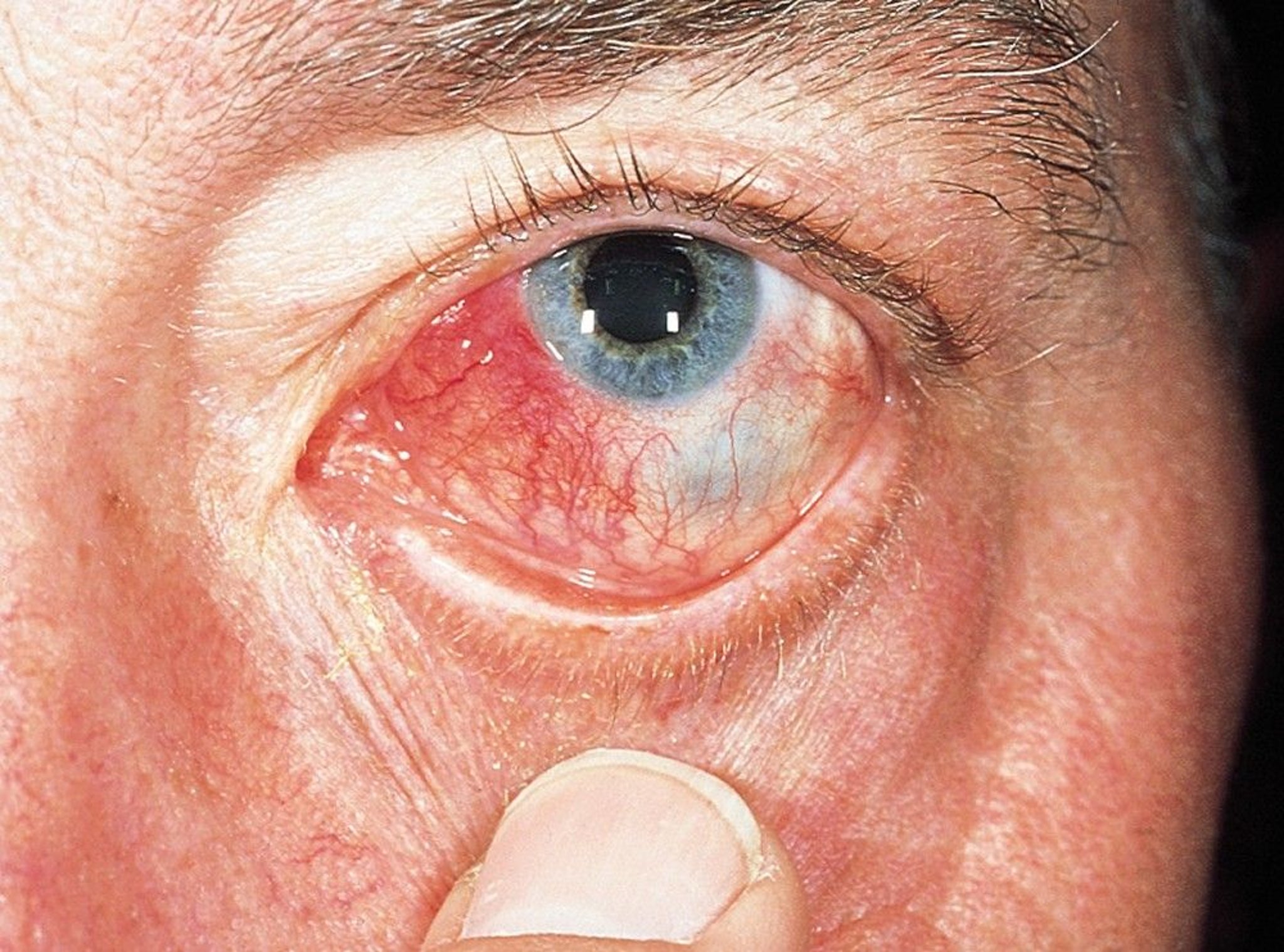 Nodular Scleritis