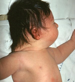 Syndrome de Down (plis nuchal redondants)