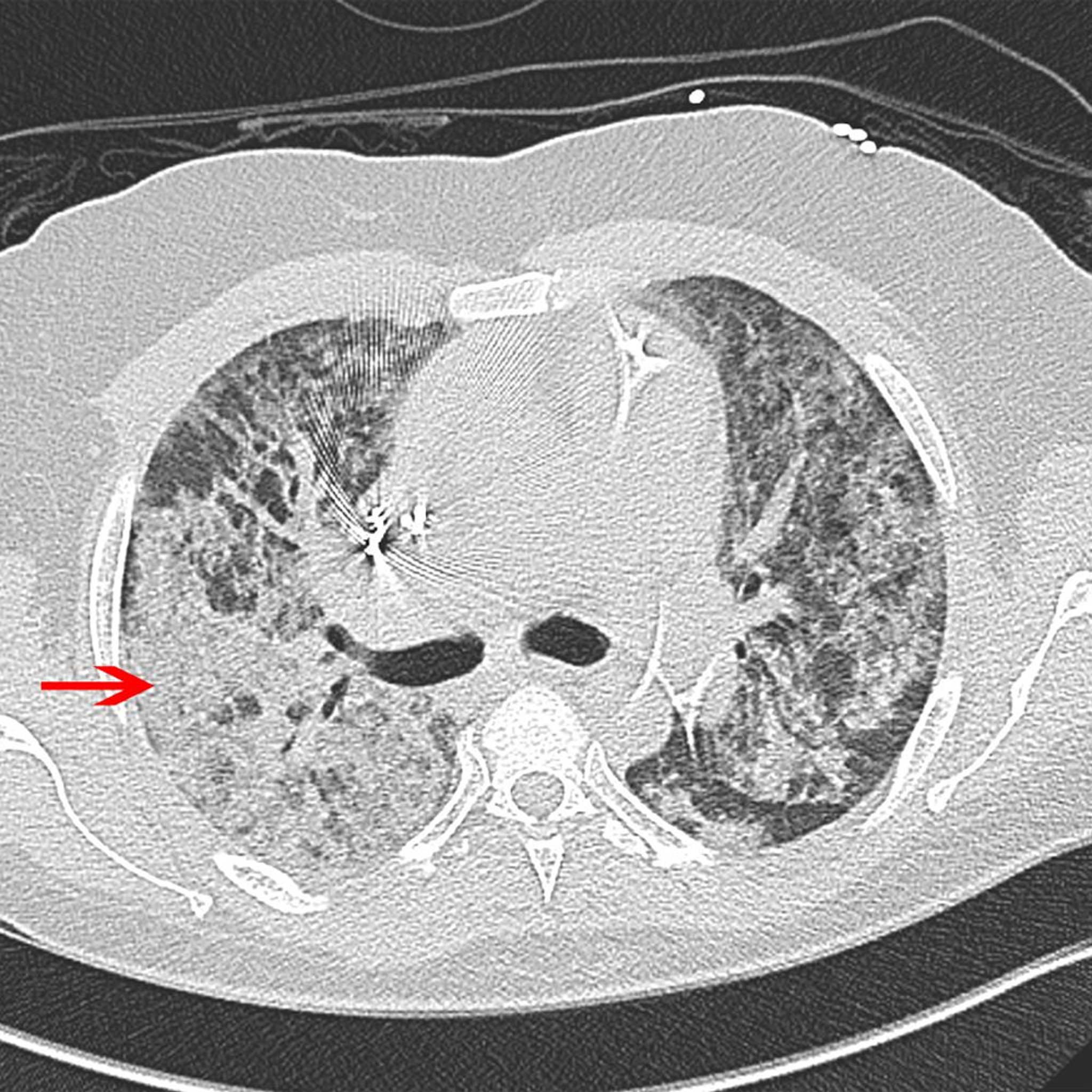 Phim chụp CT của một bệnh nhân bị ARDS