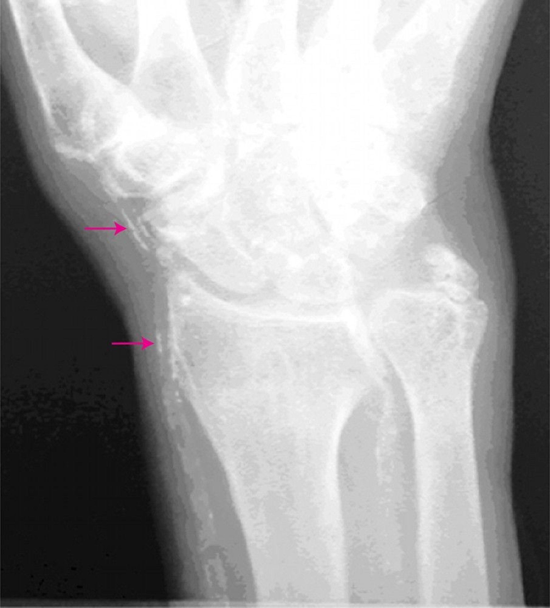 Mönckeberg Medial Calcific Sclerosis