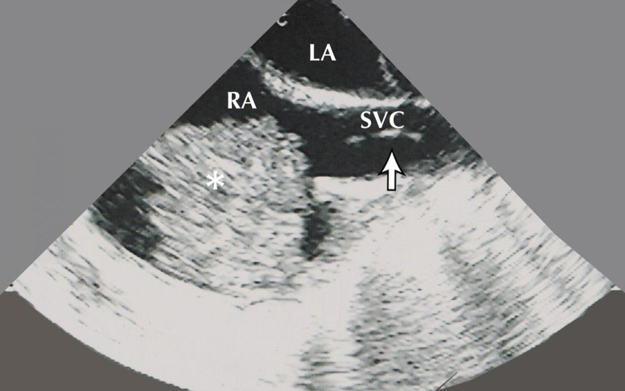 Atrial Myxoma (Echocardiogram)