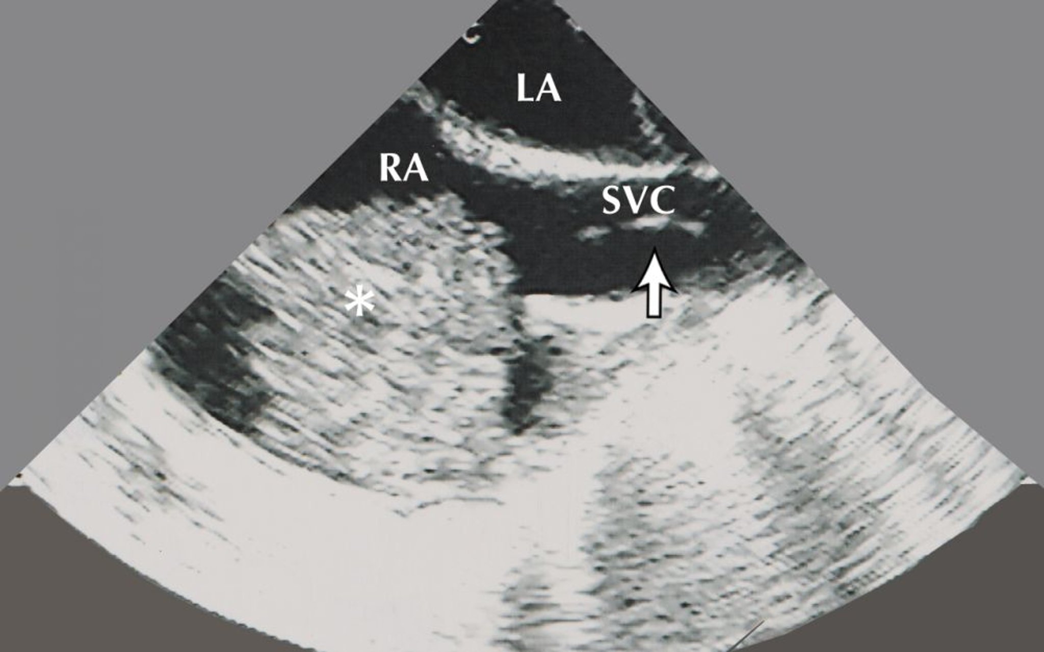 Mixoma auricular (ecocardiografía)