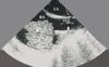 Mixoma atrial (ecocardiograma)
