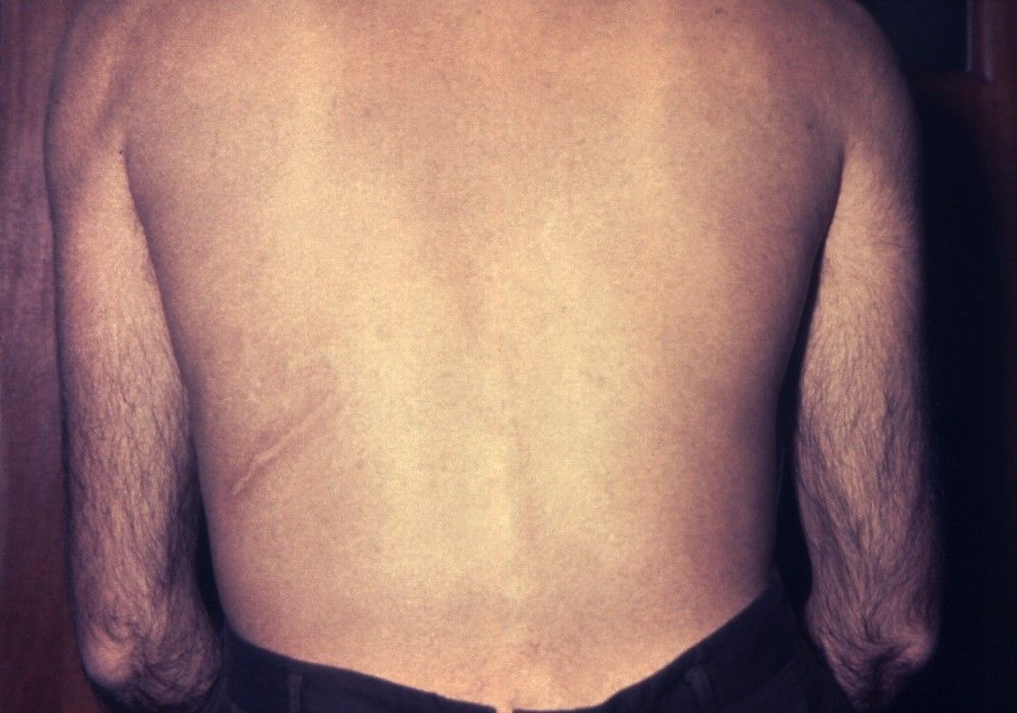 Larva Currens (Creeping Infection)