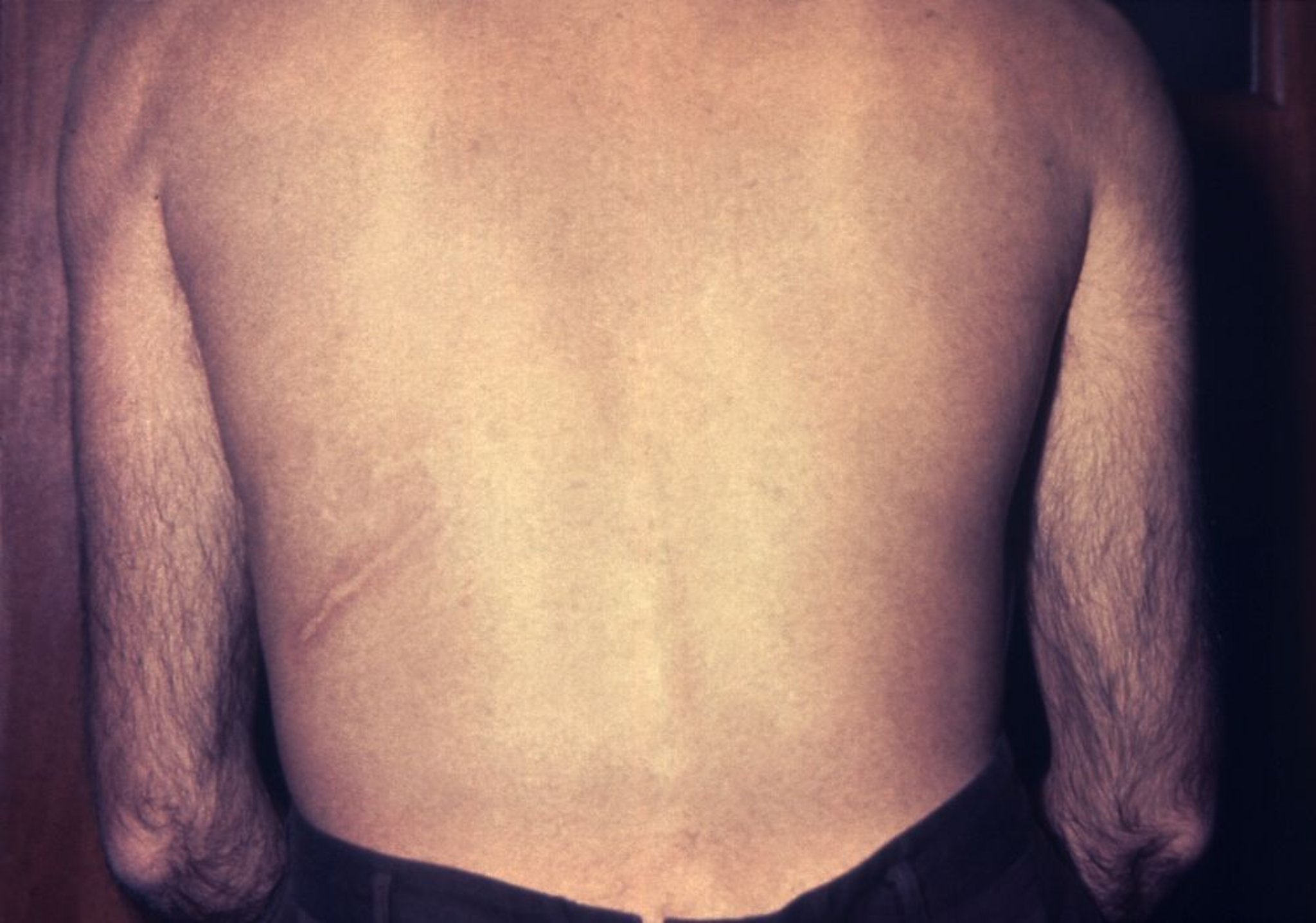 Ấu trùng Currens (Nhiễm trùng leo)