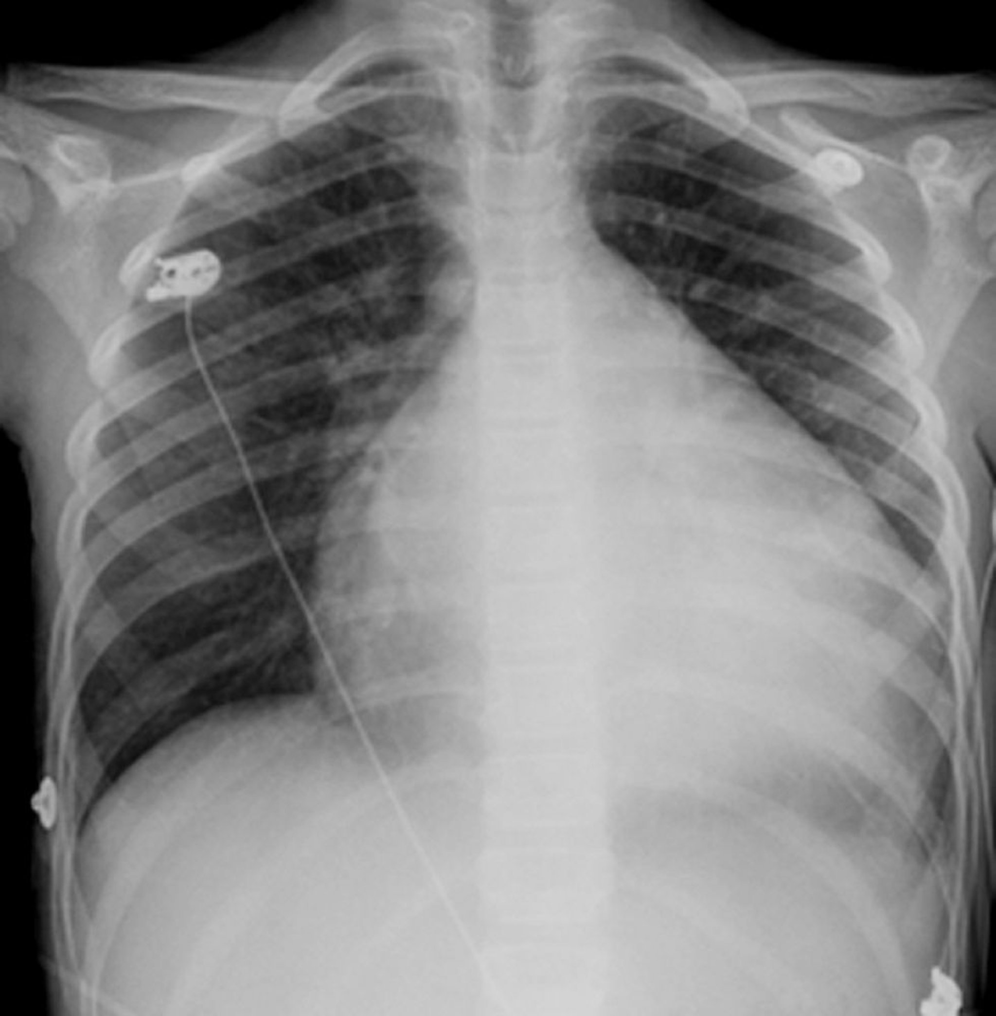 Cardiomiopatia dilatada (radiografia de tórax)