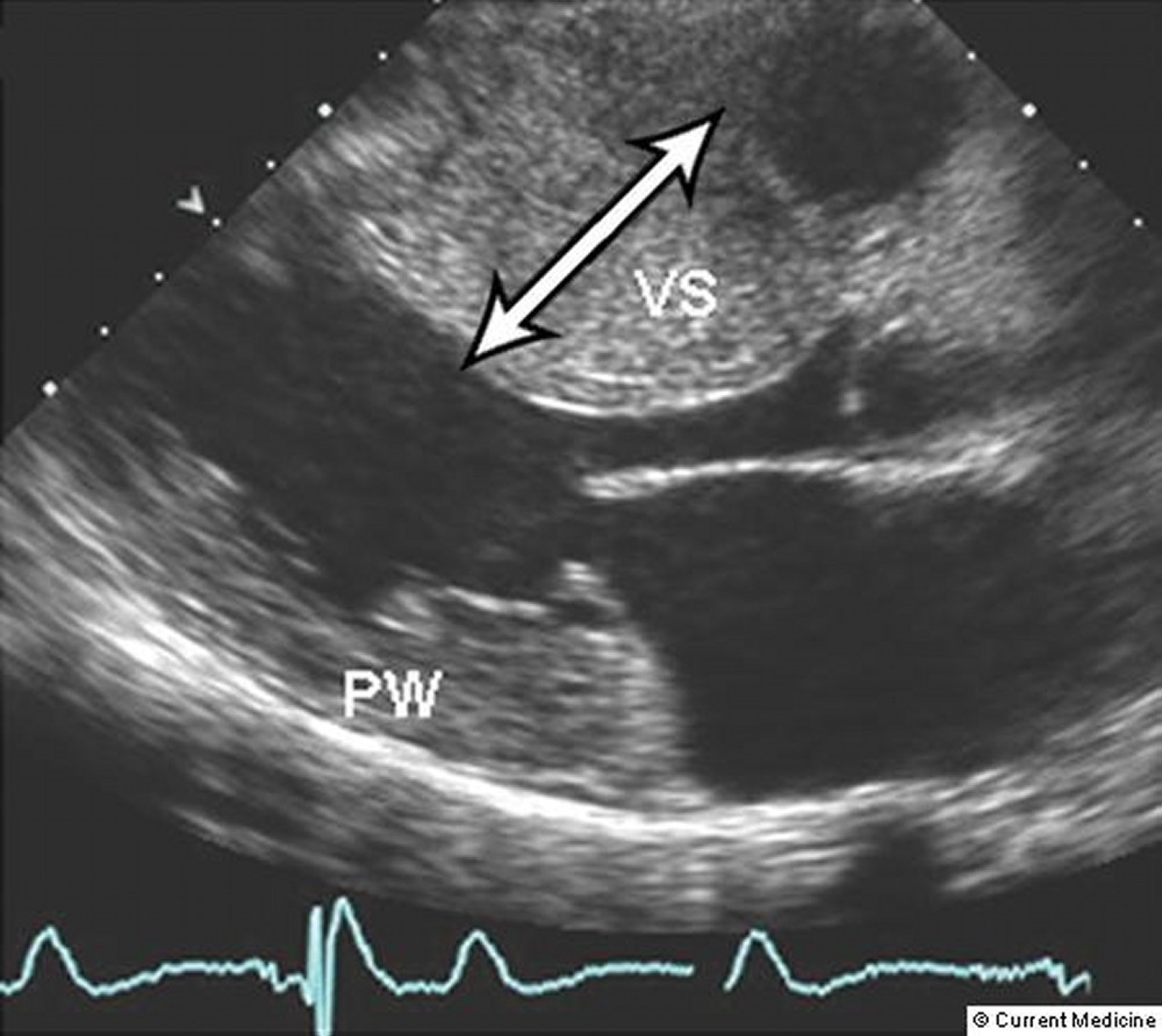 Hypertrophic Cardiomyopathy (Echocardiogram)