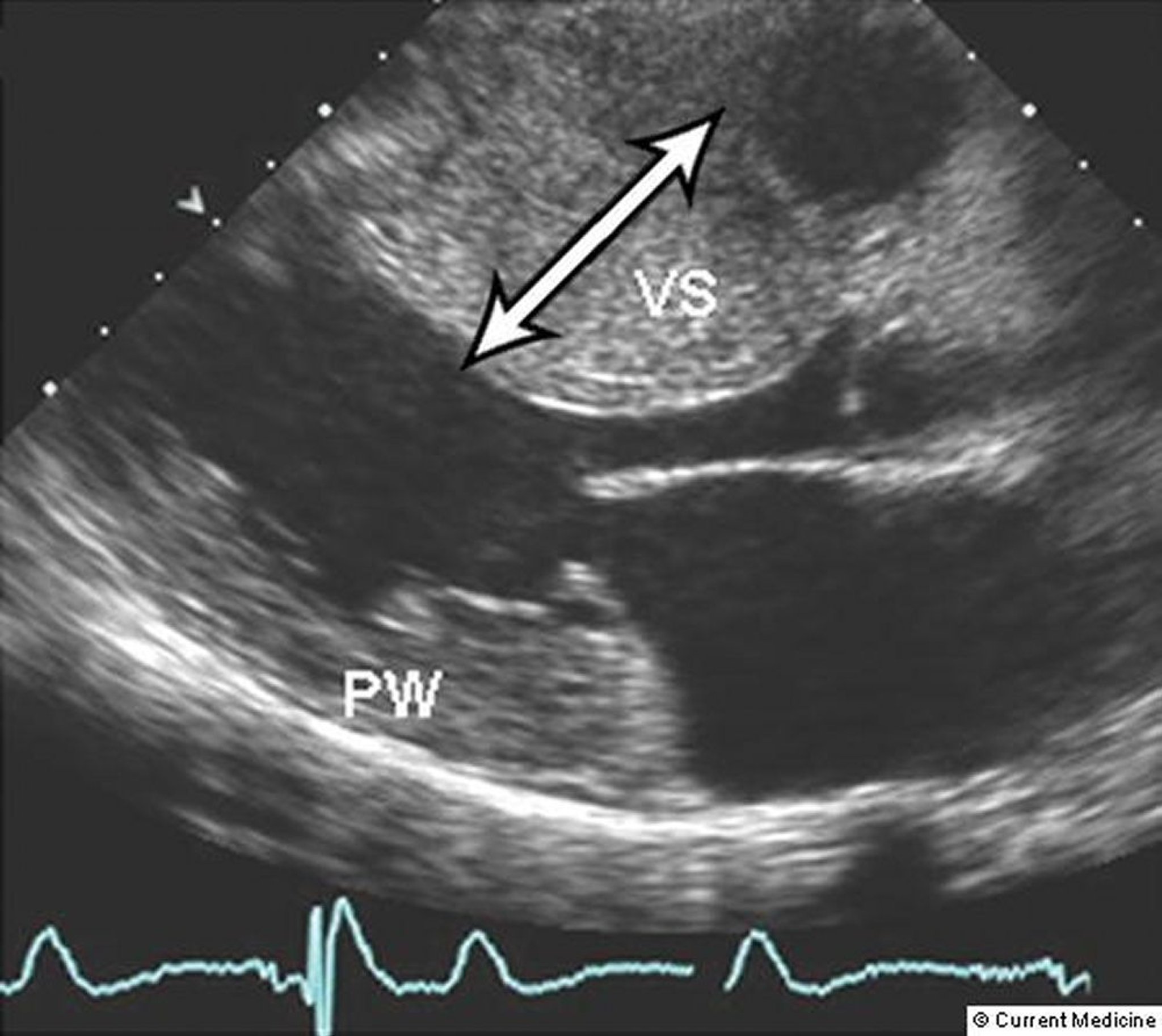 Hypertrophe Kardiomyopathie (Echokardiogramm)