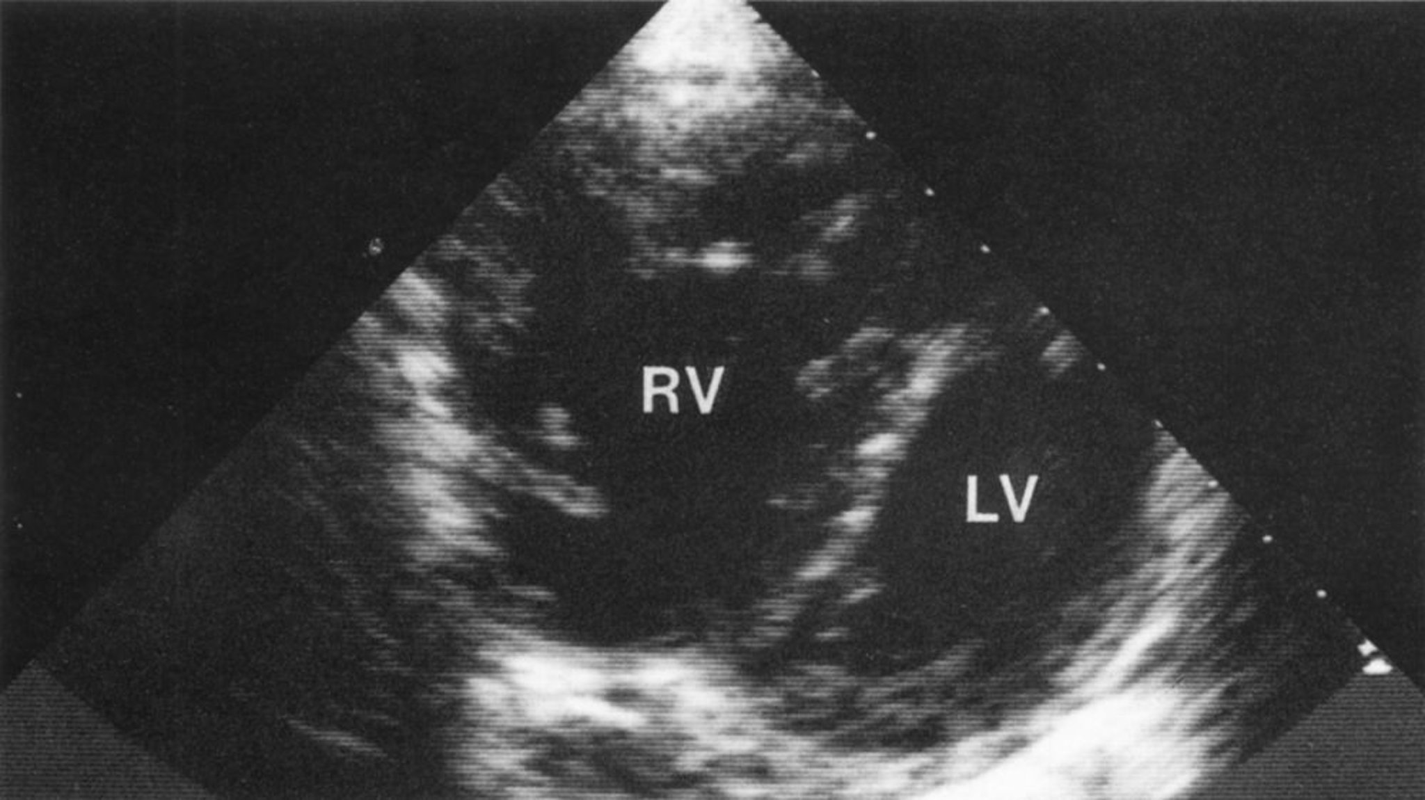 Cœur pulmonaire (échocardiogramme)