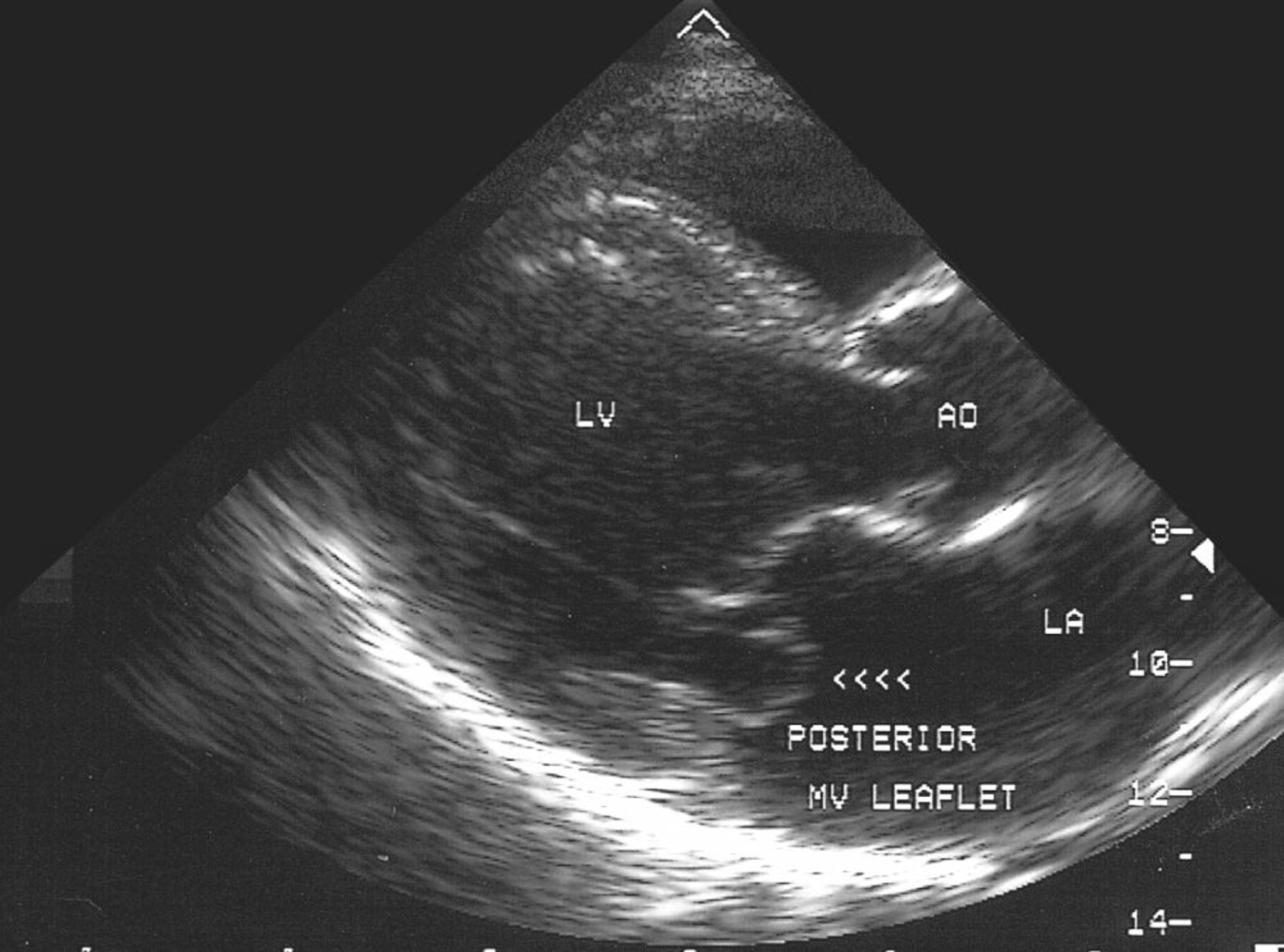 Prolapsus valvulaire mitral (échocardiogramme)