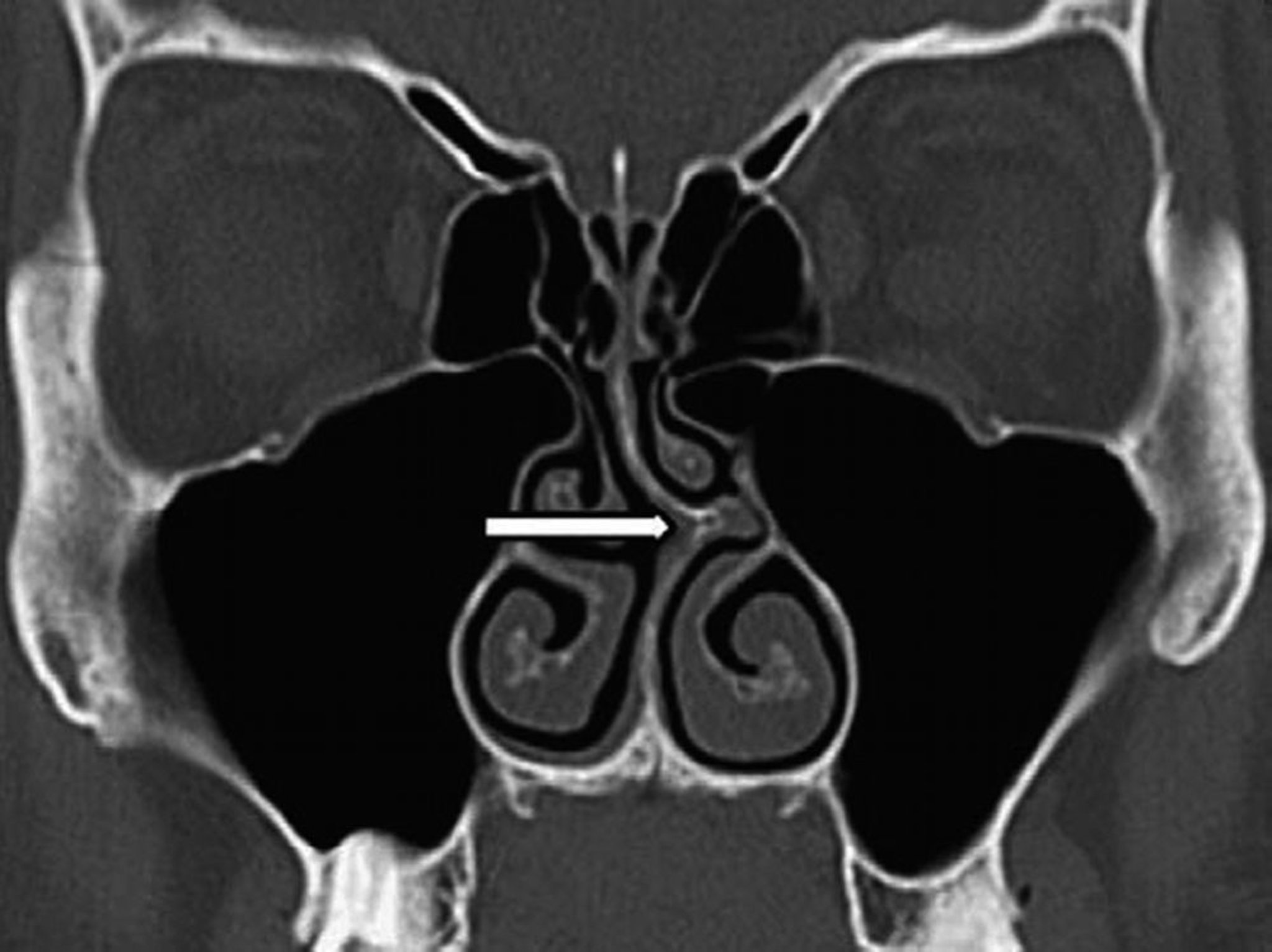 Septal Deviation (CT Scan)
