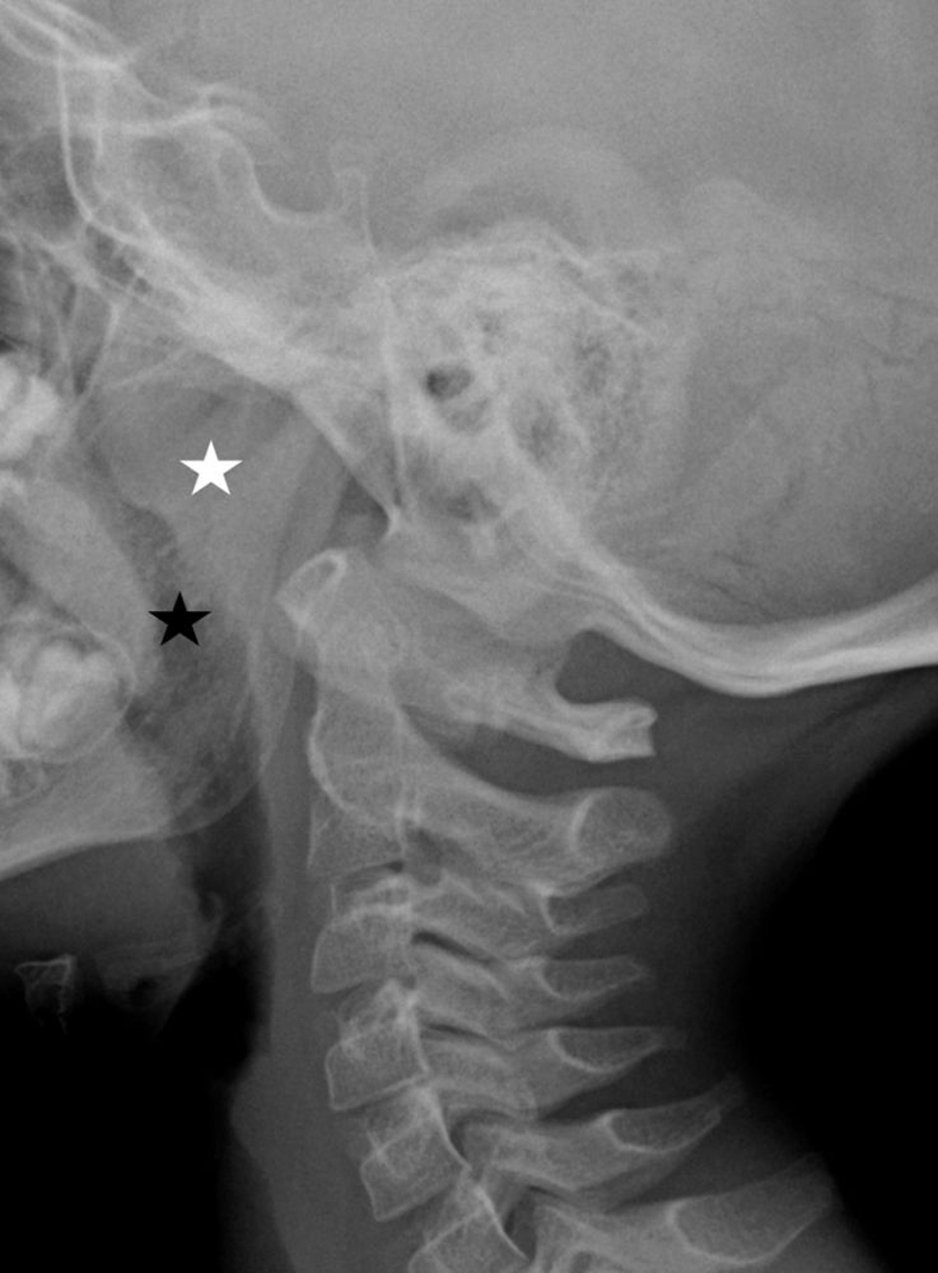 Adenoides agrandados (radiografía)