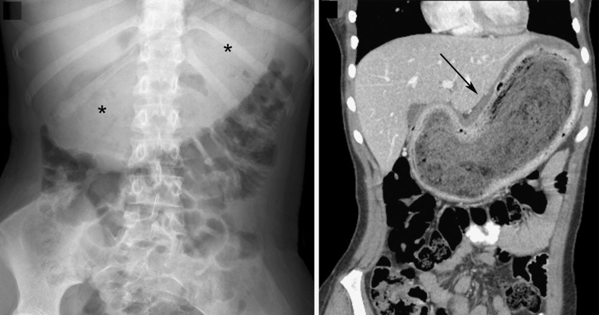 Bezoar (reperti radiografici con imaging)