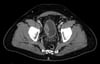 Cancro alla vescica (scansione TC)