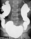 Néphropathie de reflux (urétrocystogramme mictionnel)