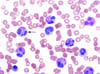 Eosinophilia (Peripheral Blood Smear)