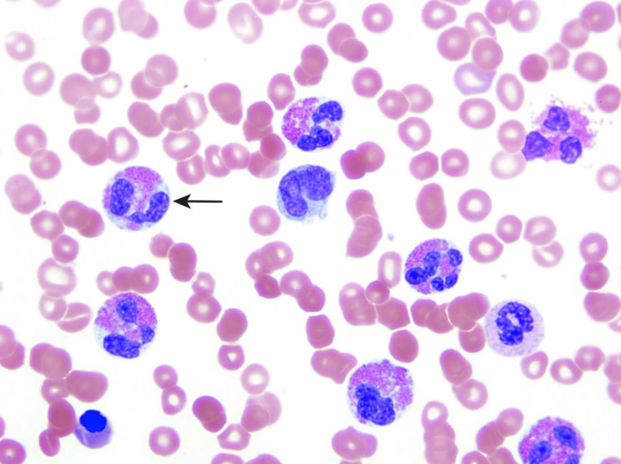 Eosinophilie (peripherer Blutausstrich)