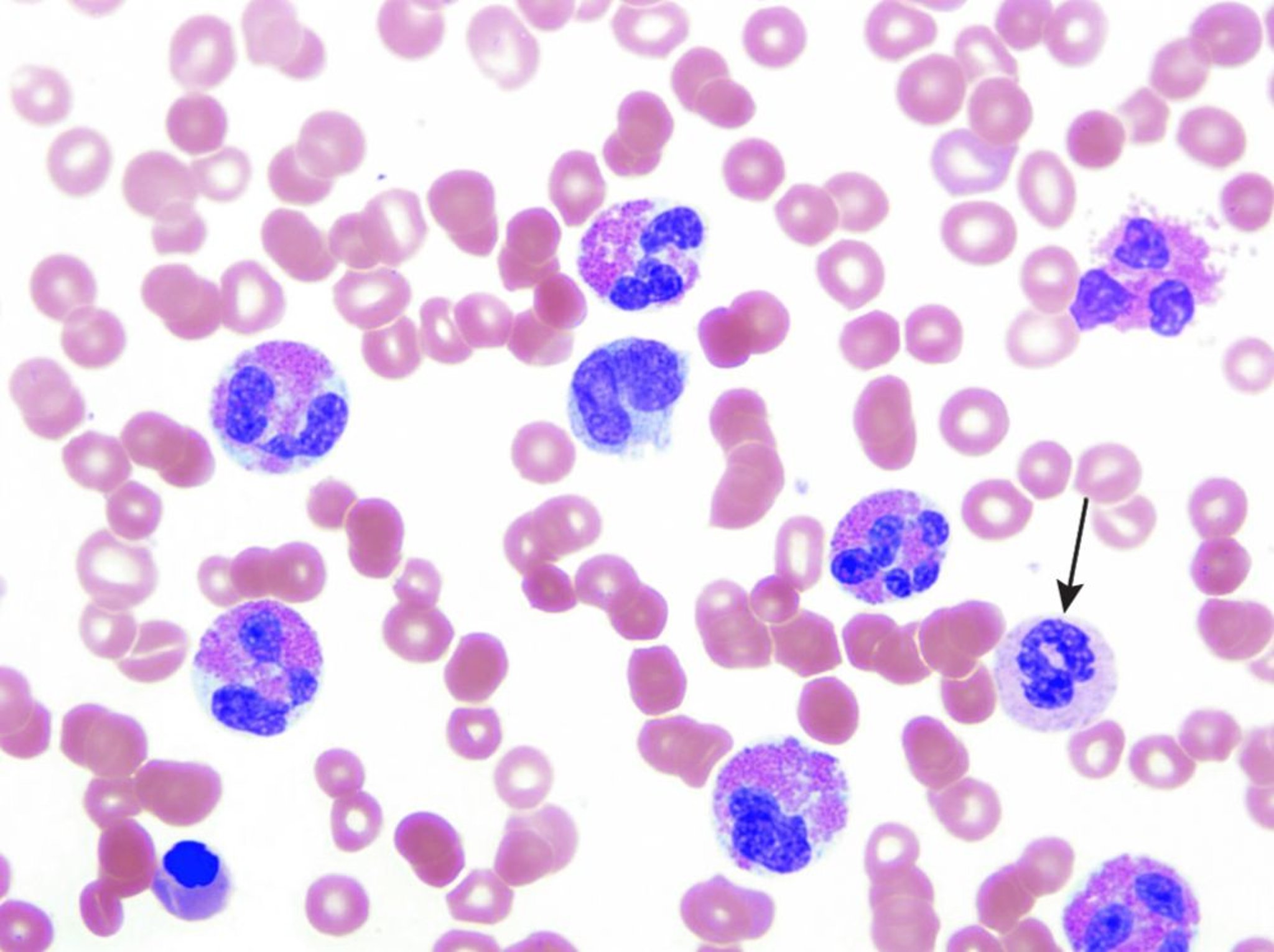 Eosinofilia (esfregaço de sangue periférico)