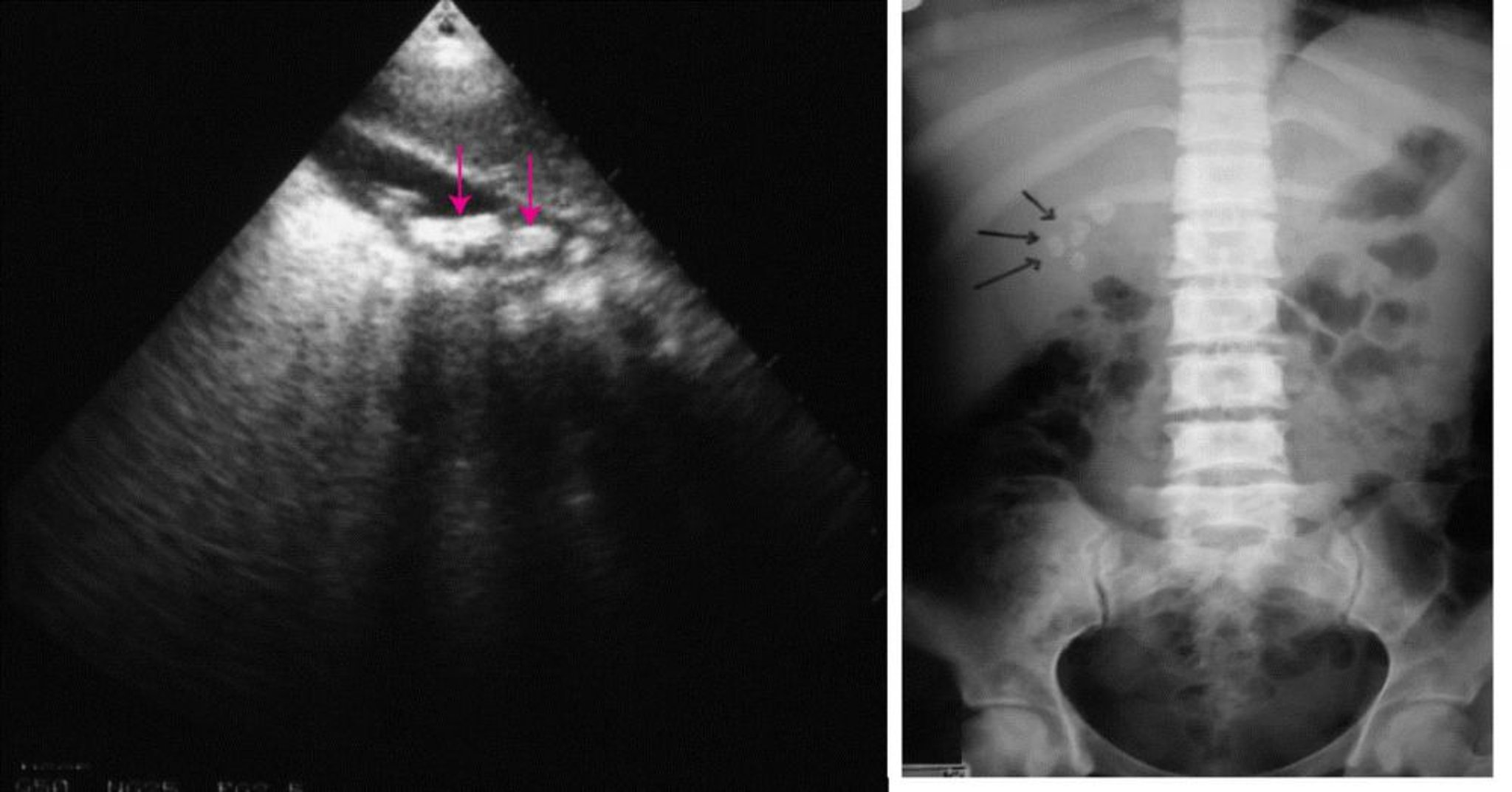 case presentation cholelithiasis