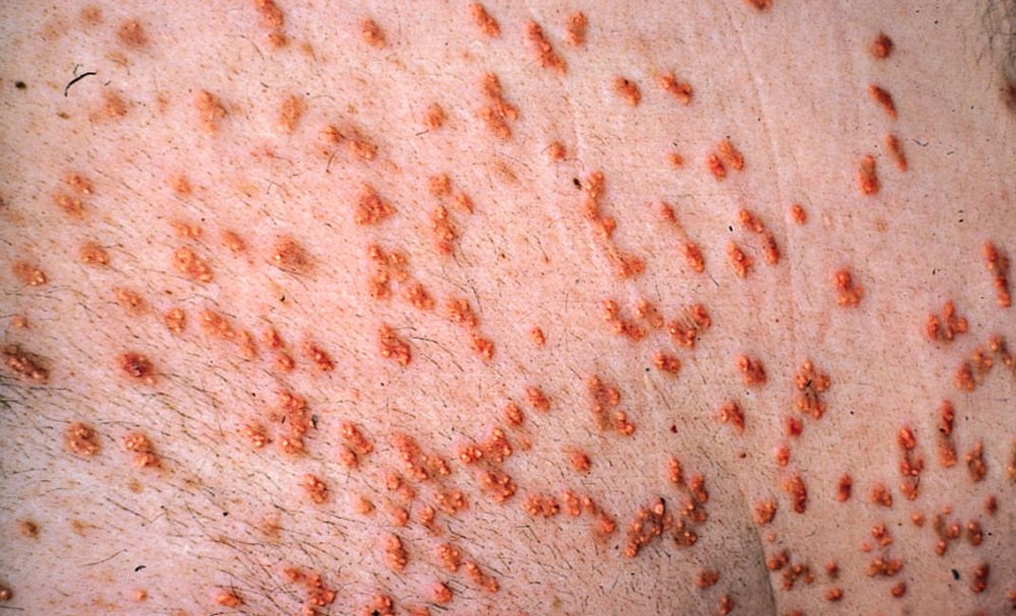発疹性黄色腫
