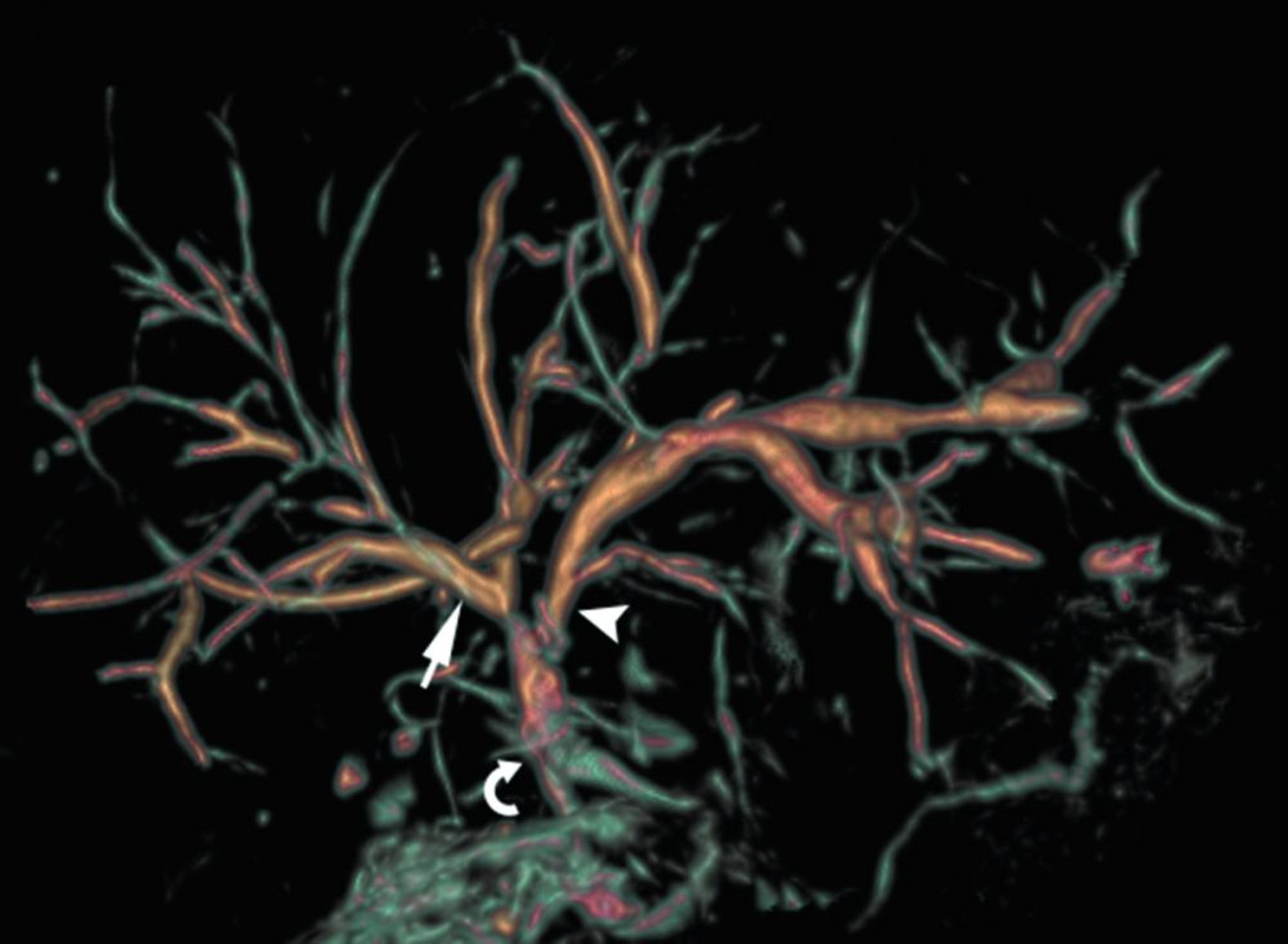 Chụp ảnh bụng (MRCP bình thường)