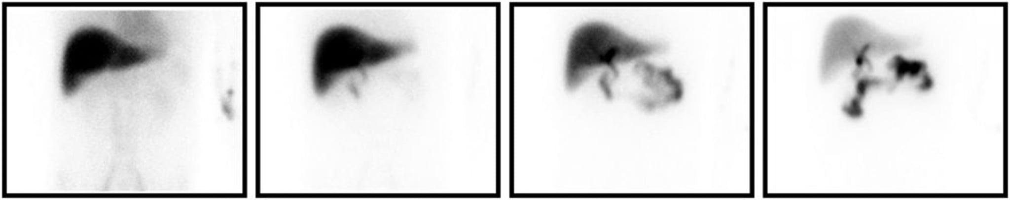 Scintigraphie à l'HIDA (hydroxyiminodiacetic acid)