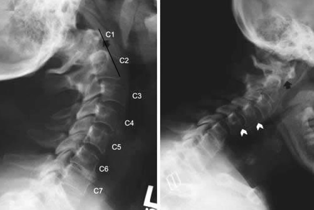 Subluxação atlantoaxial