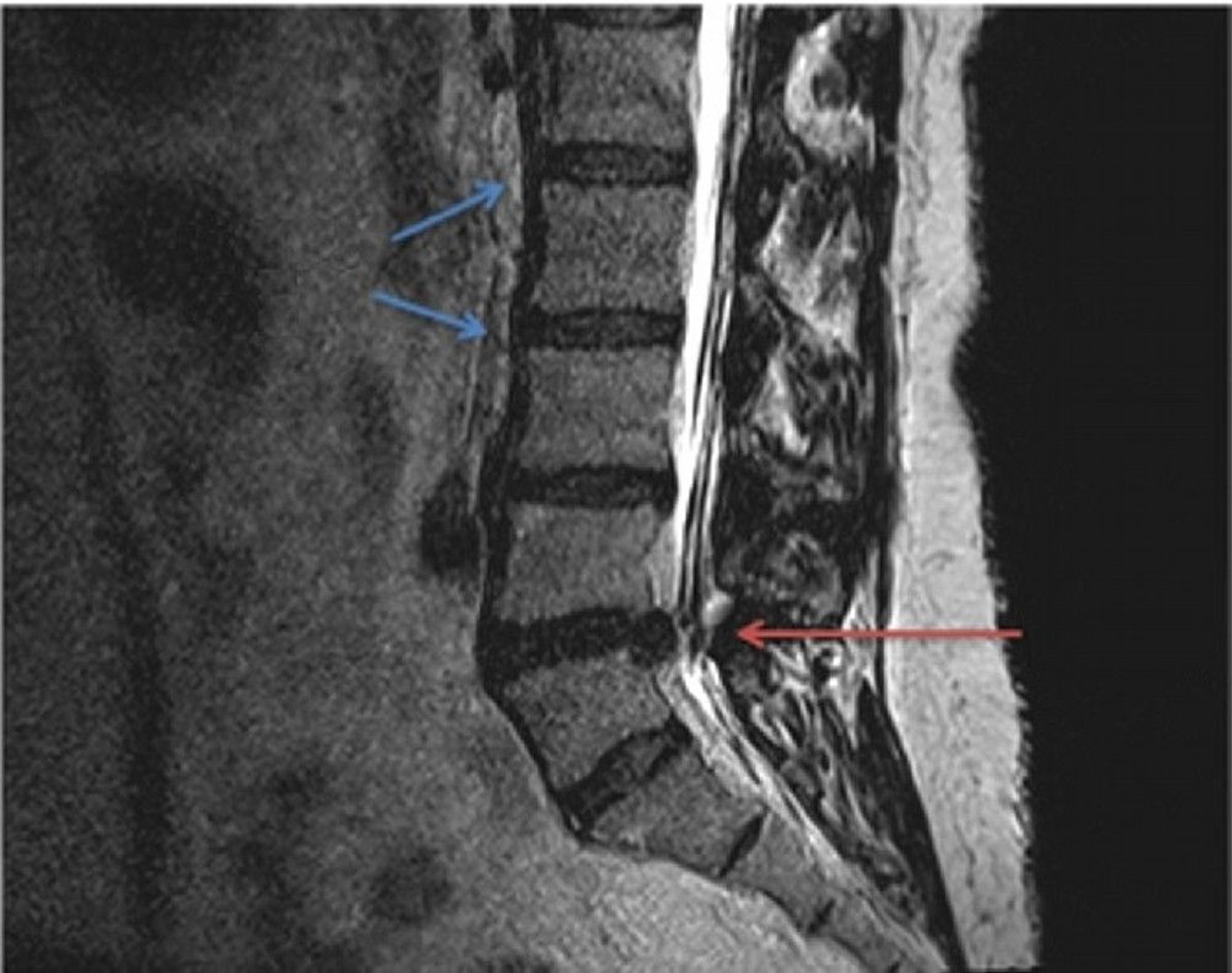 Herniated Disc (MRI Scan)