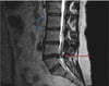 Hernia de disco (RM)