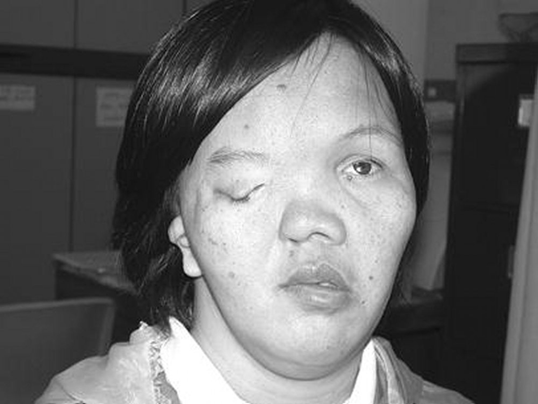 Tật không nhãn cầu