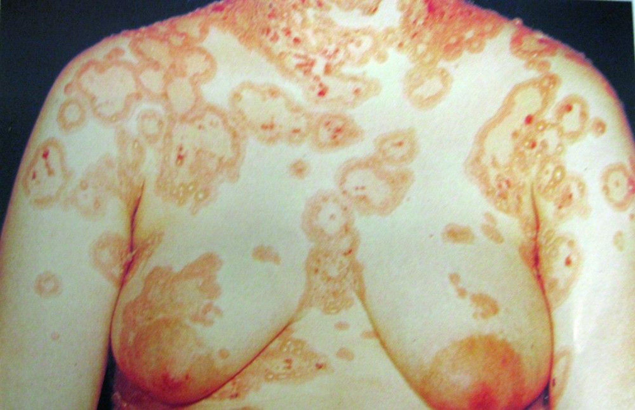 Pemphigoid Gestationis