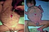 Prune-Belly-Syndrom