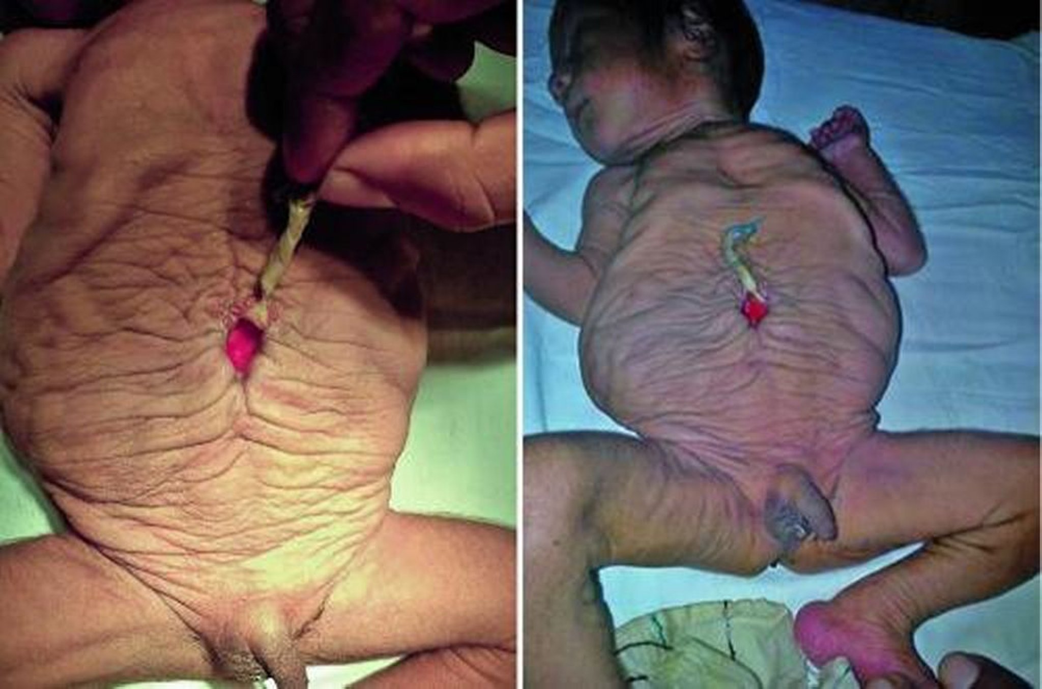 Prune-Belly-Syndrom