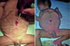 Síndrome de abdomen en ciruela pasa