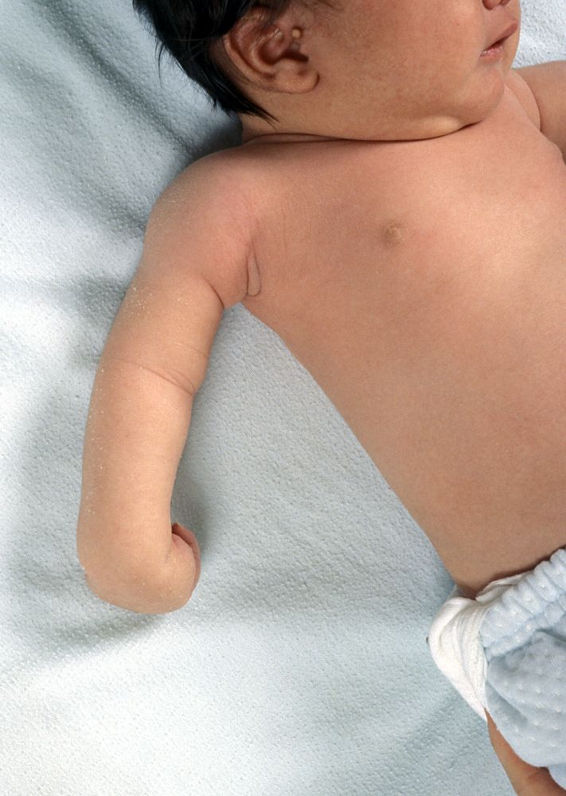 Paralisia de Erb em um recém-nascido