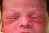 Erythema toxicum