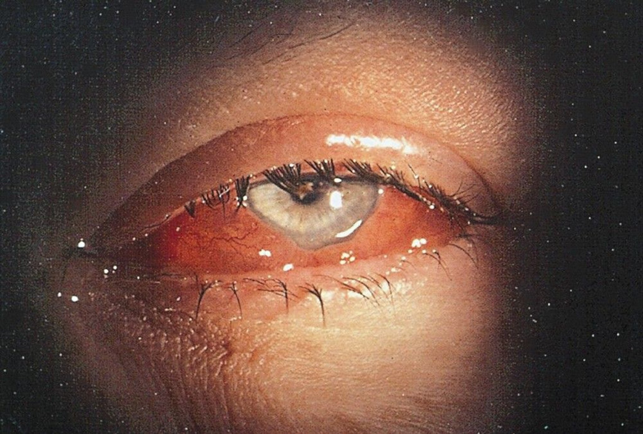 Acute Conjunctival Chemosis