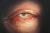Akute Bindehautchemosis