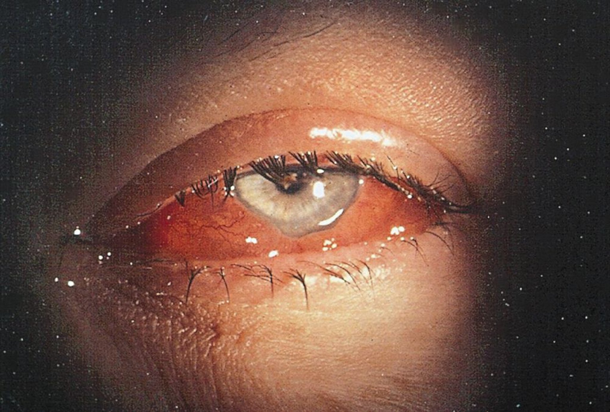 Quemosis conjuntival aguda