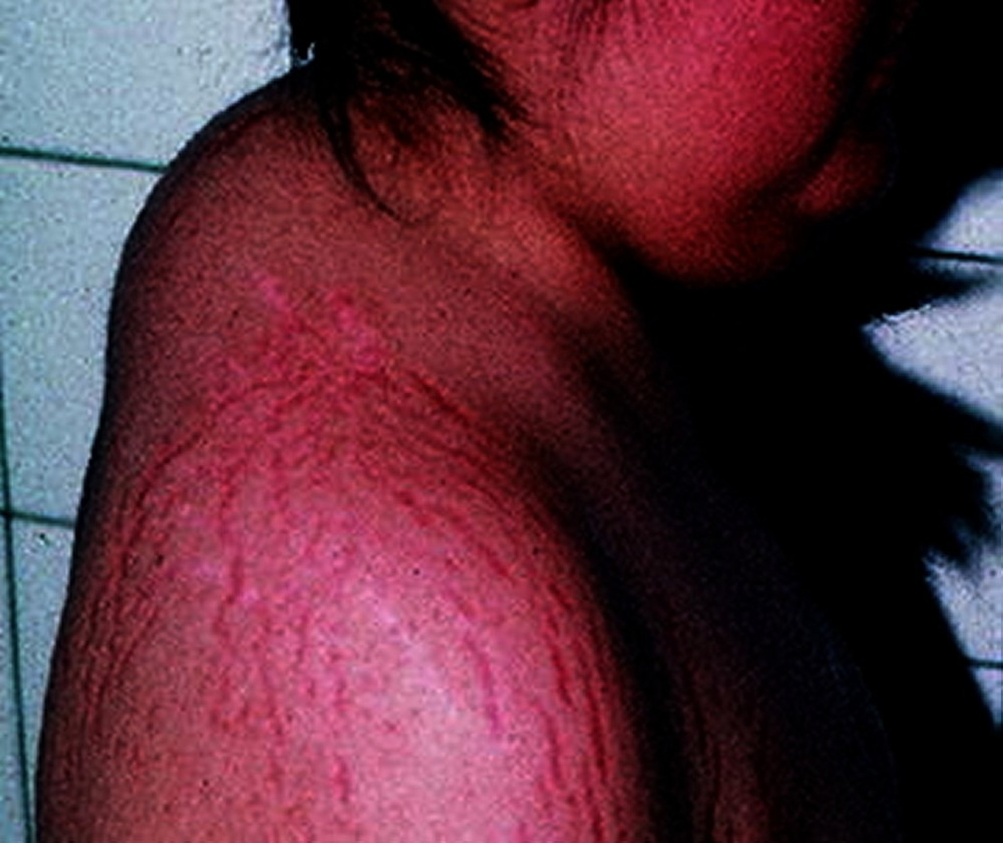 Cushing Syndrome (Buffalo Hump and Striae)