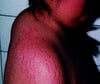 Sindrome di Cushing (gobba di bufalo e striae)