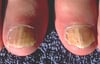 Onychomycose des gros orteils