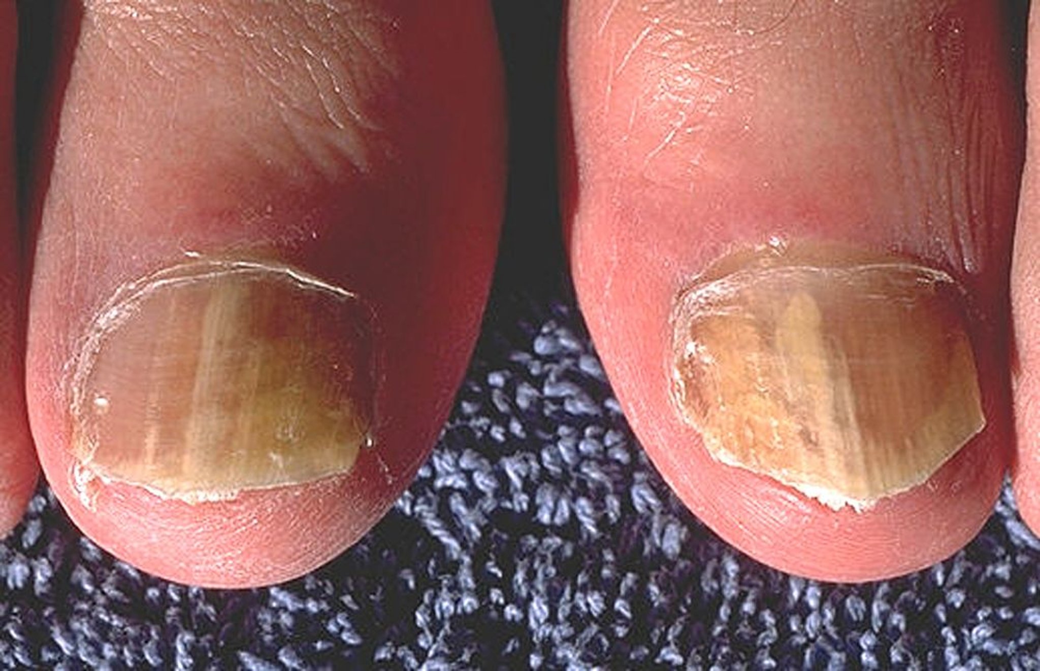 Bệnh nấm móng ở ngón chân cái