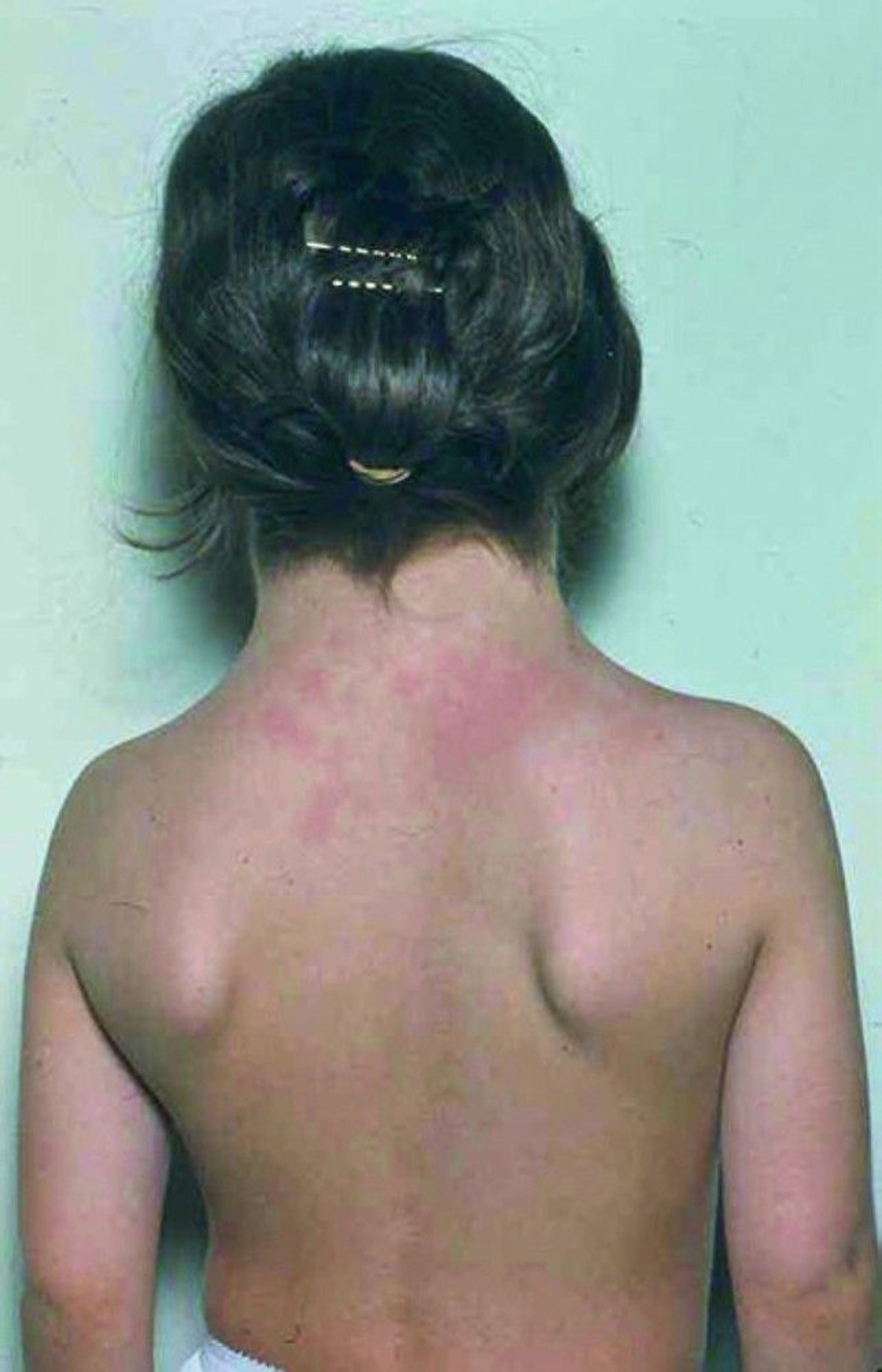 Turner Syndrome (Upper Skeletal Features)