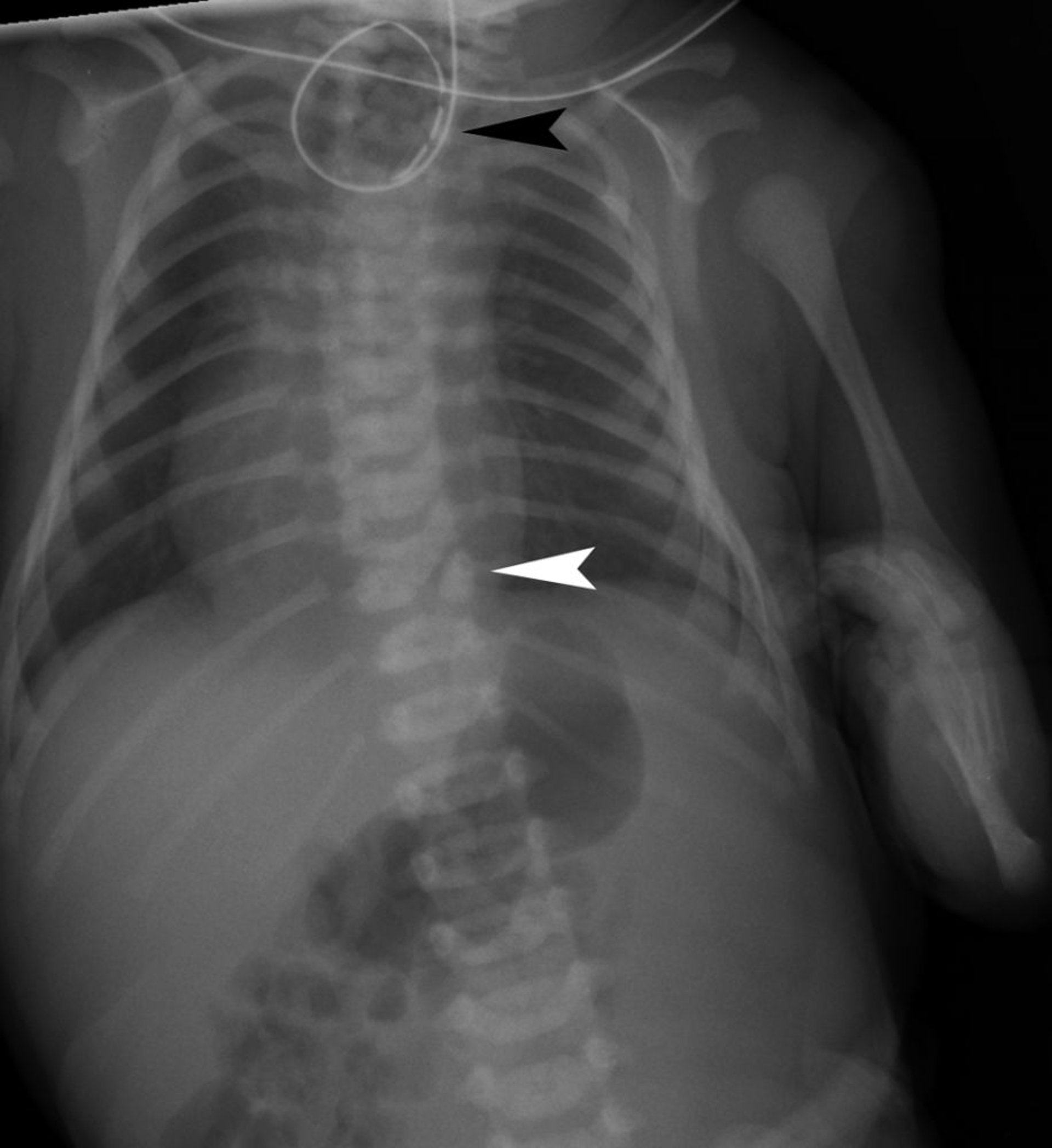 VACTERL (X-Ray Anomalies)